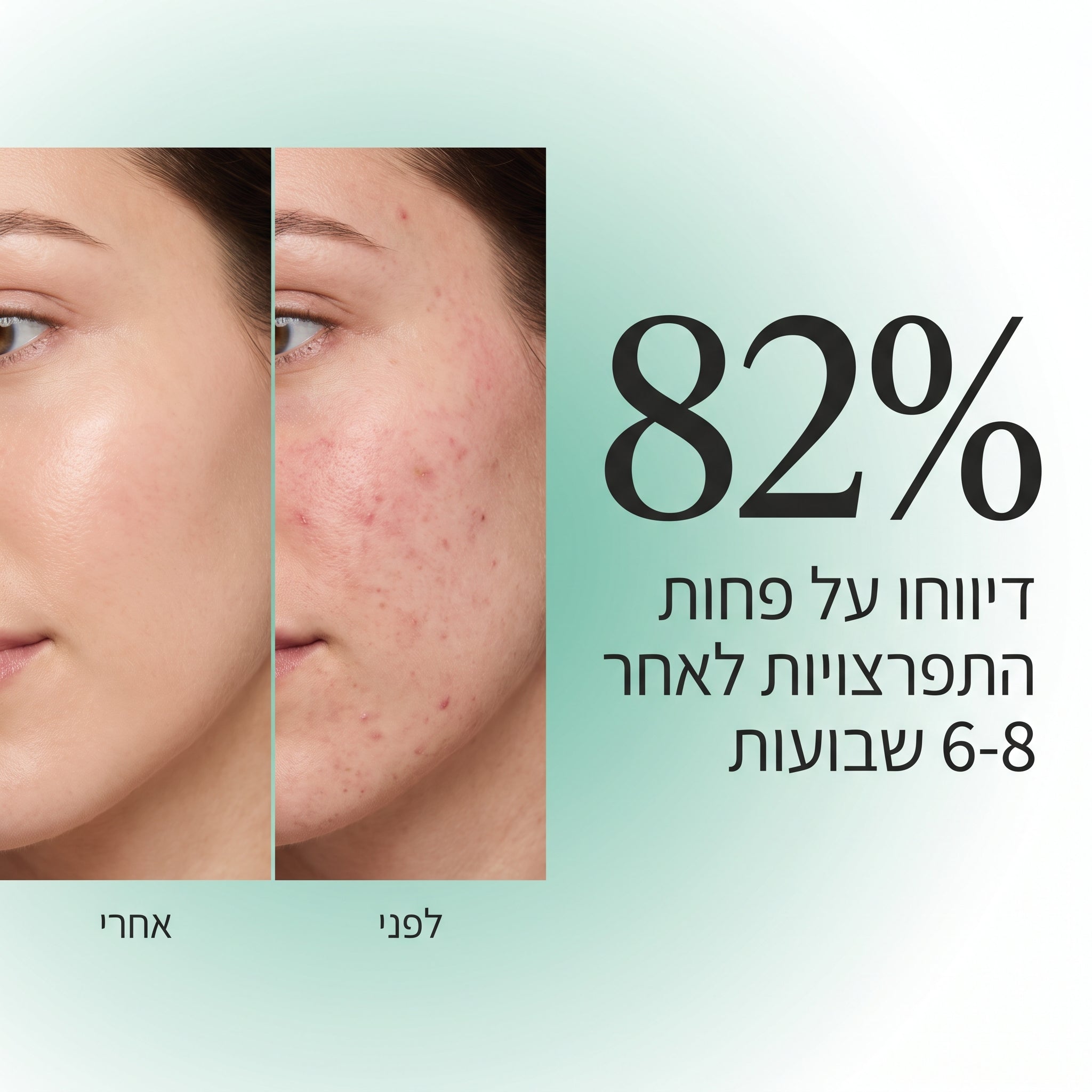 AcneClear - פתרון מתקדם לפצעי וצלקות אקנה