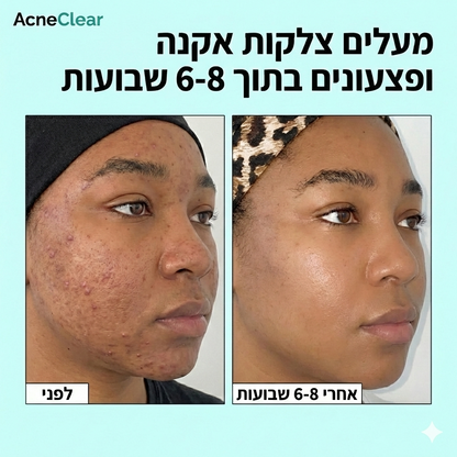 Acneclear - פתרון מתקדם לבעיות אקנה
