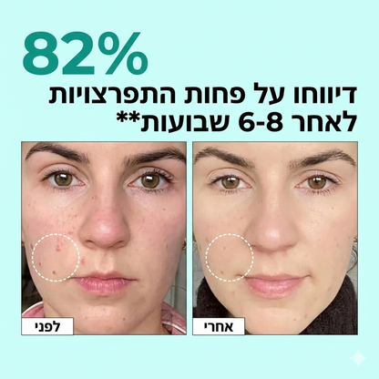 Acneclear - פתרון מתקדם לבעיות אקנה
